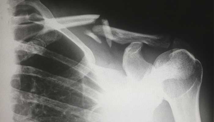 X-ray of injured shoulder with broken bones.